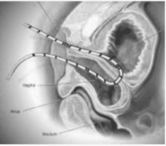 Surgical Experimentation by the 'Father of Gynaecology' on African American Slaves Surgical Experimentation by the 'Father of Gynaecology' on African American Slaves